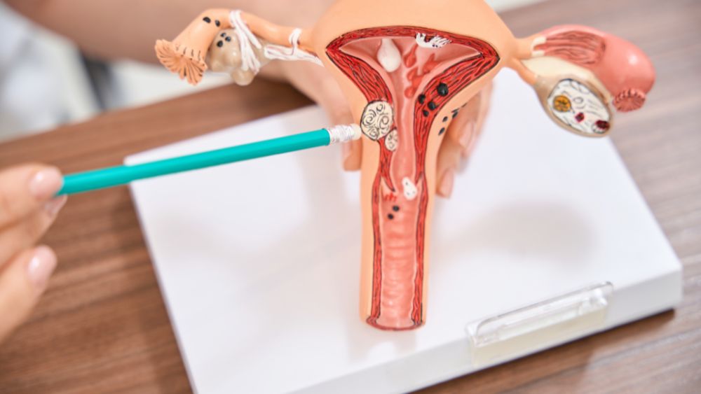 Cross-sectional illustration showing endometrial tissue growing into uterine muscle